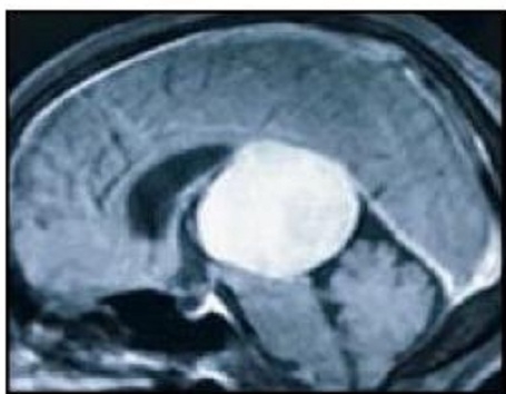 ball sized tumour _1 