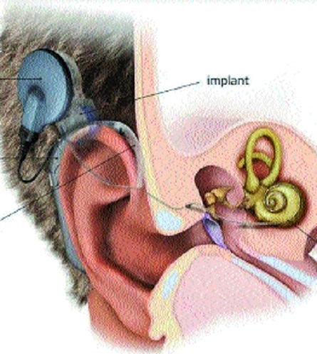 13 Cochlear Implants_1&nb