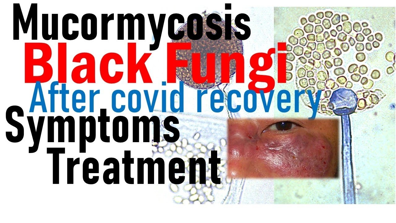 Mucormycosis _1&nbsp;&nbs