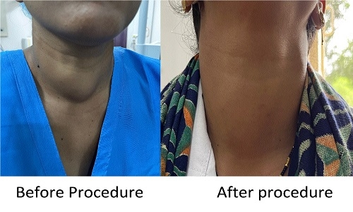 Microwave Ablation technique