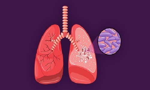 Record number of TB cases notified in Durg - Vimarsana News