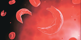 sickle cell