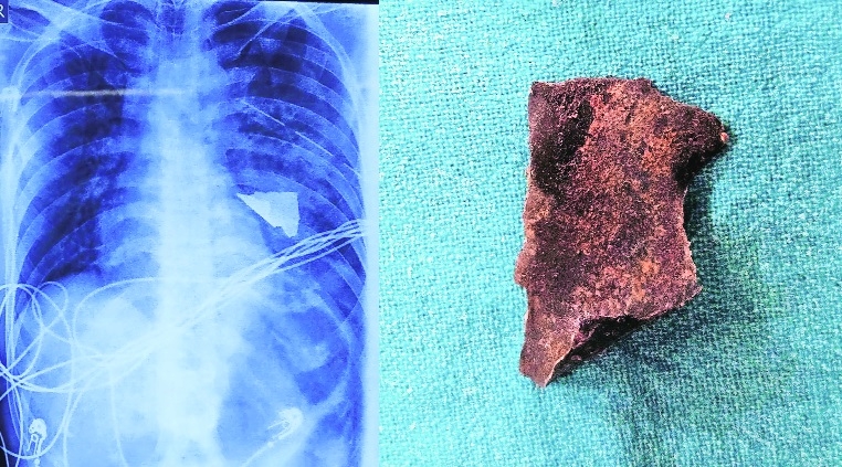 The metalic fragment is visible in X-ray