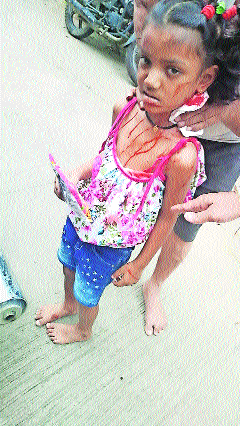 5-year-old girl injured  in attack by stray 