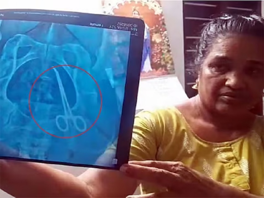 Surgical instrument found in womans abdomen 5 yrs after surgery in Kerala
