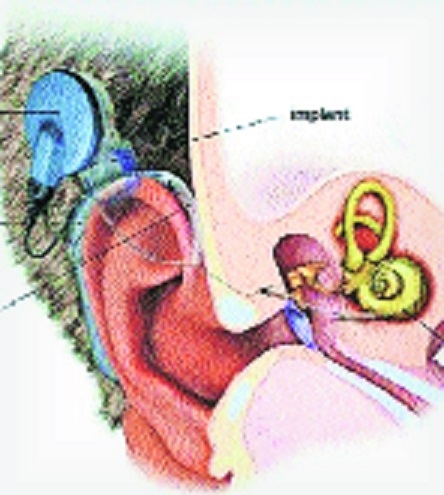 MJPJAY to Ayushman Cochlear implant procedures come to a standstill in State