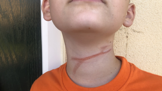 11-year-old boy dies after dog leash gets tangled around neck