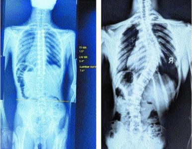 Robotic technology used in straightening teenage Scoliosis patient’s spine at AIIMS