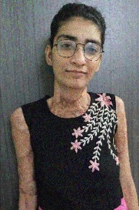 Burn survivor Maninder Kaur shines in JEE from Raipur