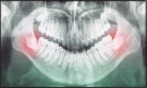 AIIMS doctors develop indigenous device to make wisdom tooth removal easier