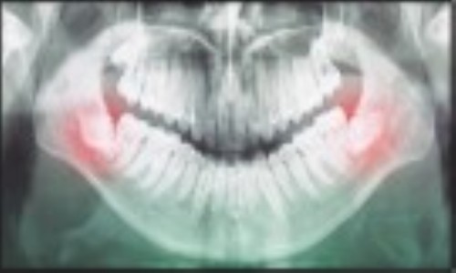 AIIMS doctors develop indigenous deviceto make wisdom tooth removal easier